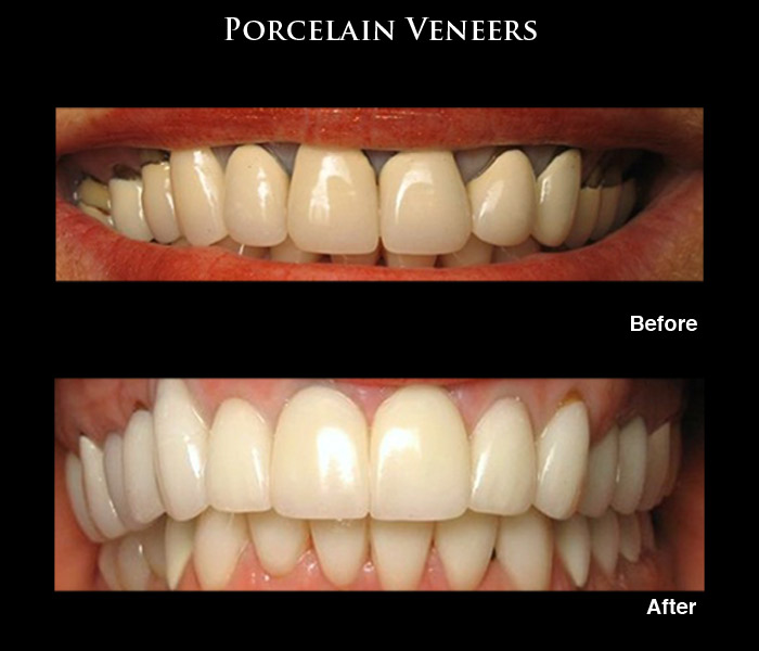 Porcelain Veneers Before & After Photos