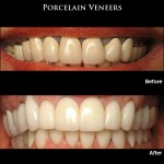 Porcelain Veneers Before & After Photos