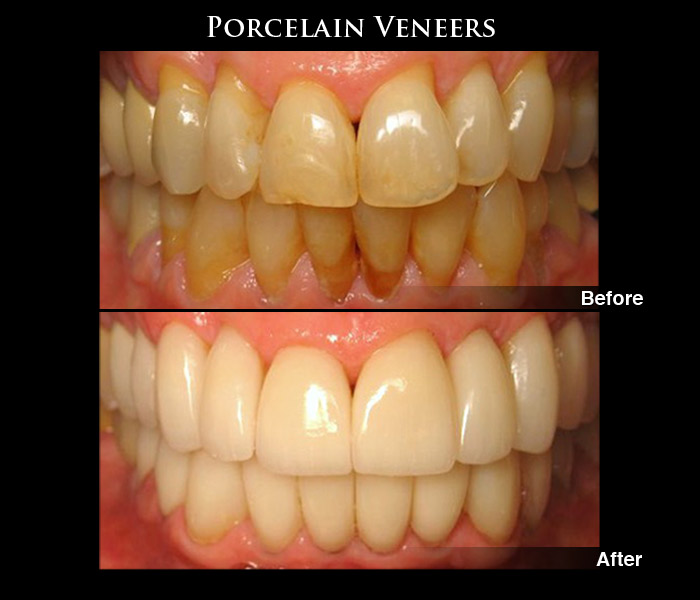 Porcelain Veneers Before & After Photos