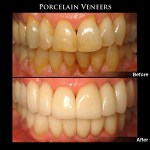 Porcelain Veneers Before & After Photos