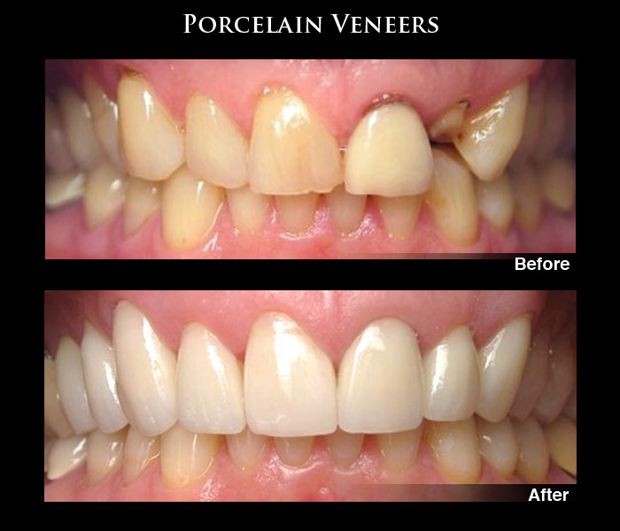 Before & After Teeth Veneers Case Study Photos