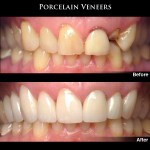 Before & After Teeth Veneers Case Study Photos