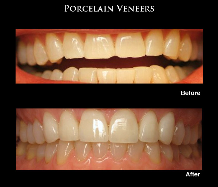 Porcelain Veneers Before and After