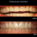 Porcelain Veneers Before and After
