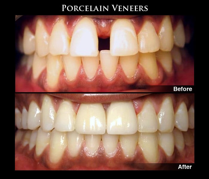 Porcelain Dental Veneers Before & After Photos
