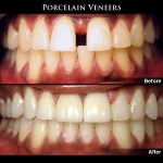 Porcelain Dental Veneers Before & After Photos
