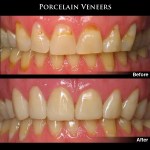 Before and After Dental Veneers Photos