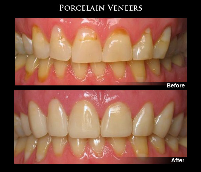 Before and After Dental Veneers Photos