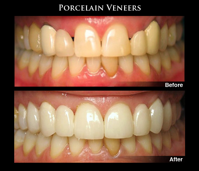 Porcelain Dental Veneers Before & After Photos, Patient Case Study