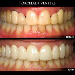 Porcelain Dental Veneers Before & After Photos, Patient Case Study