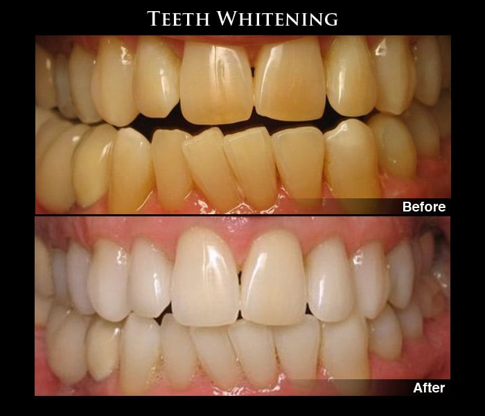 Before and after Photos of Teeth Whitening