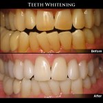 Before and after Photos of Teeth Whitening