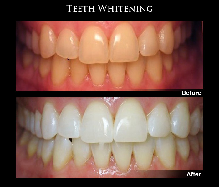 Teeth Whitening Before & After Photos