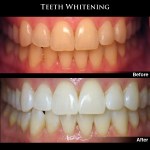 Teeth Whitening Before & After Photos